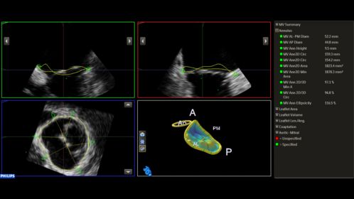 Ultrasound Workspace Mitral Valve Navigator