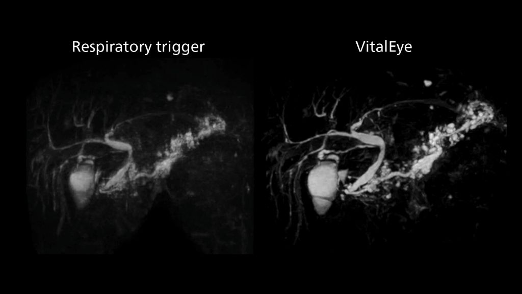 3D MRCP with respiratory gated imaging using VitalEye vs. using traditional breathing sensor set up