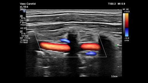 eL18-4 Vertebral Perfusion with Flow Viewer