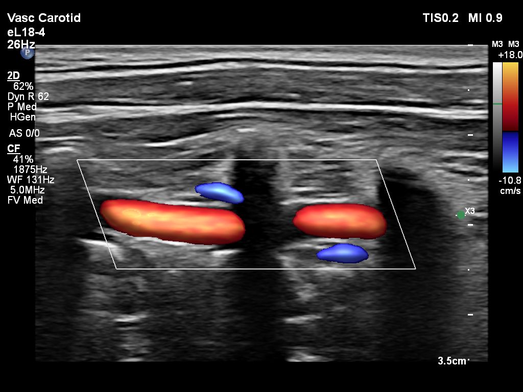 eL18-4 Vertebral Imaging