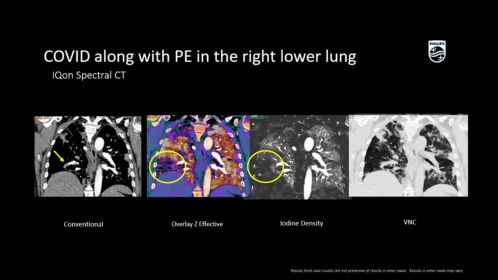 IQon Spectral COVID along with PE in right lower lung