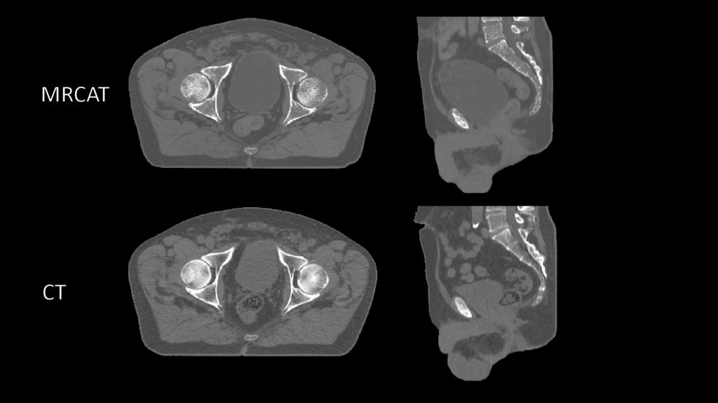 MRCAT vs CT image