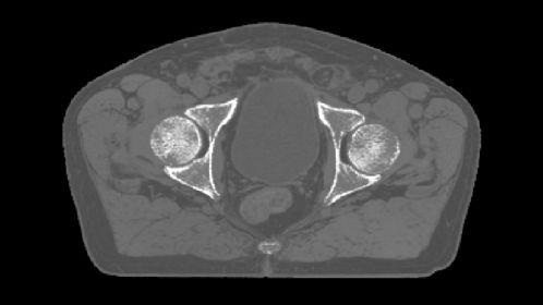 MRCAT Pelvis with Continuous Hounsfield units