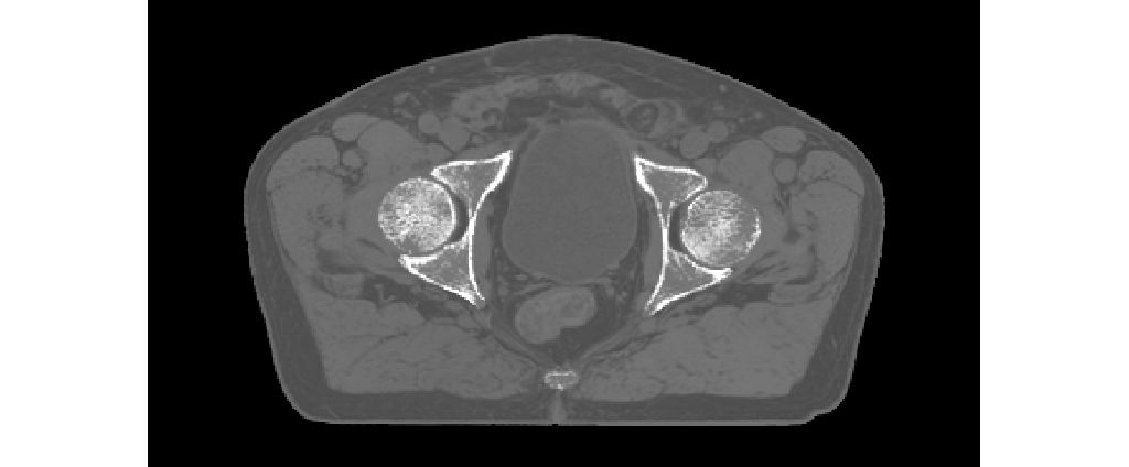MRCAT Pelvis with Continuous Hounsfield units