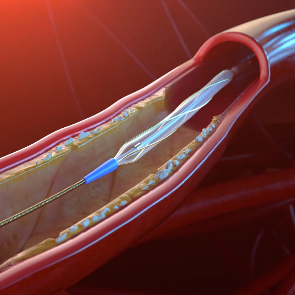 Safety: Low dissection rate¹,²