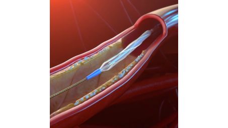 Safety: ~1x force post scoring for low dissection rate