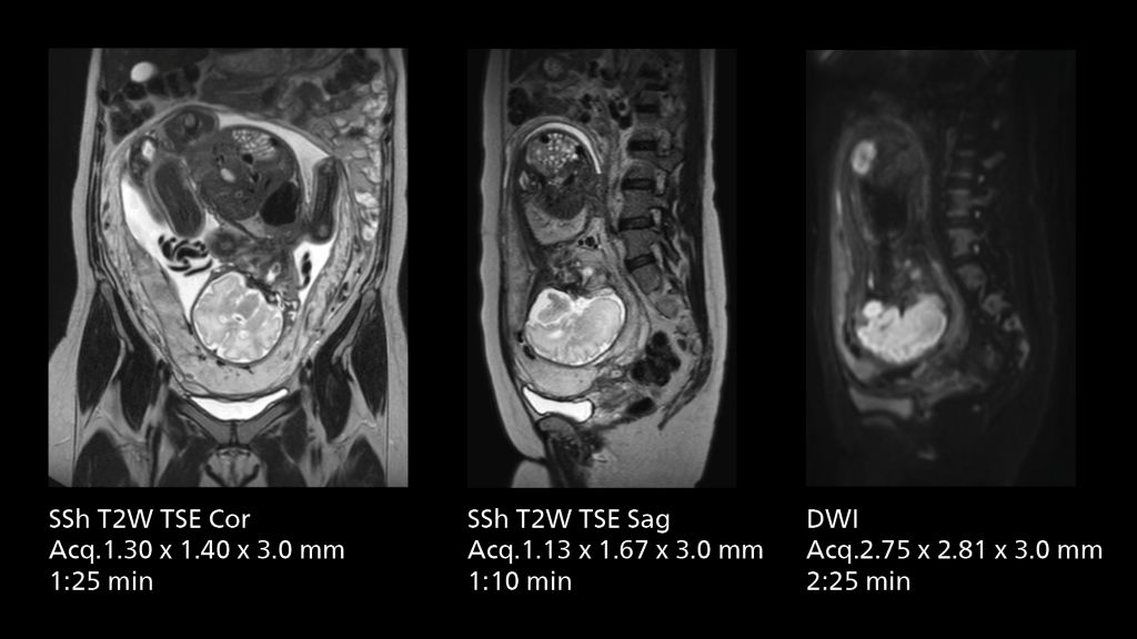 Routine fetal imaging using single shot TSE, SmartSpeed AI and SmartSpeed DWI. 