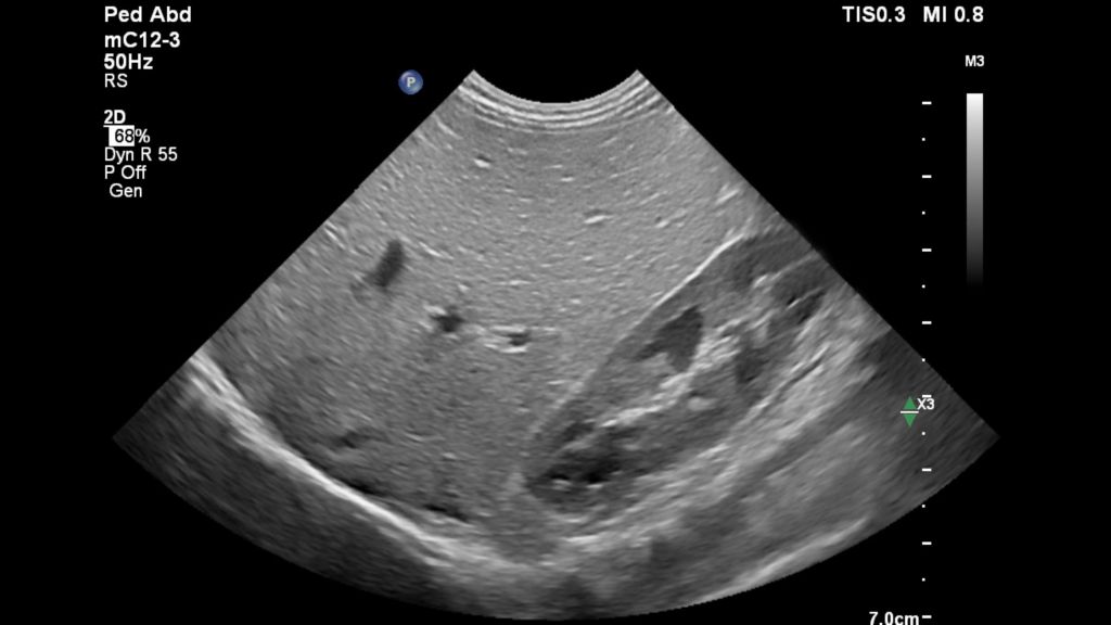 Pediatric Liver and Kidney