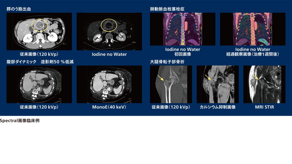 兵庫県立淡路医療センター 製品導入事例 – IQon スペクトラル CT