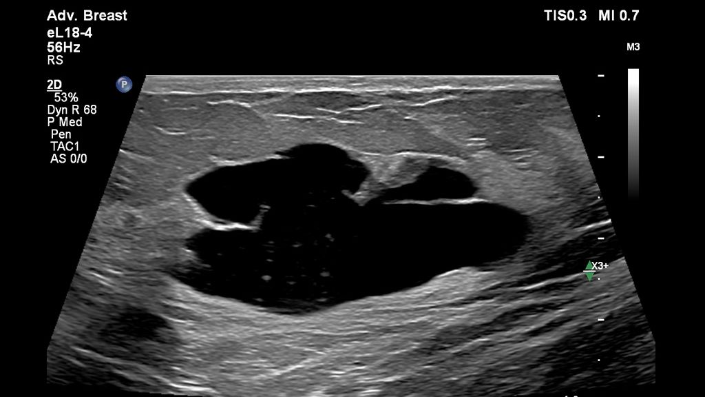 Clinical image using EPIQ Elite and eL18-4 transducer to show breast trapezoid cyst in 2D