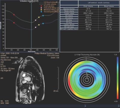 MR Cardiac Viewing | Philips