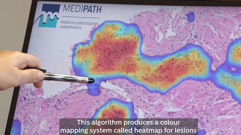 Pathologist demonstrating an on-screen digital pathology color mapping system for lesions*