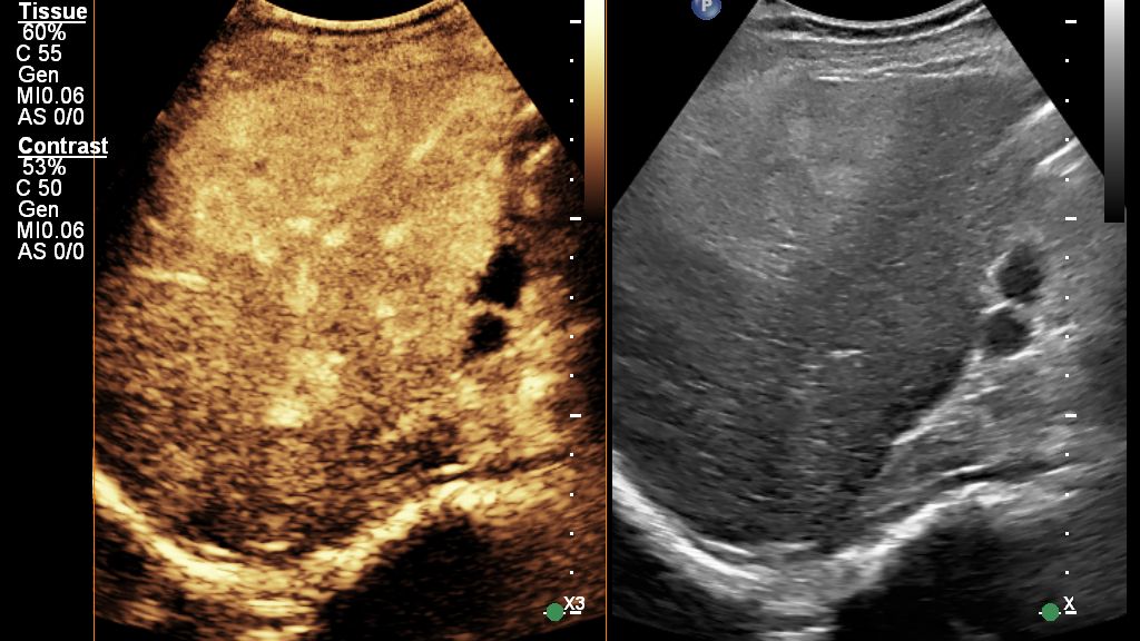 EPIQ Elite Elevate with C5-1 probe for Liver CEUS Auto Scan