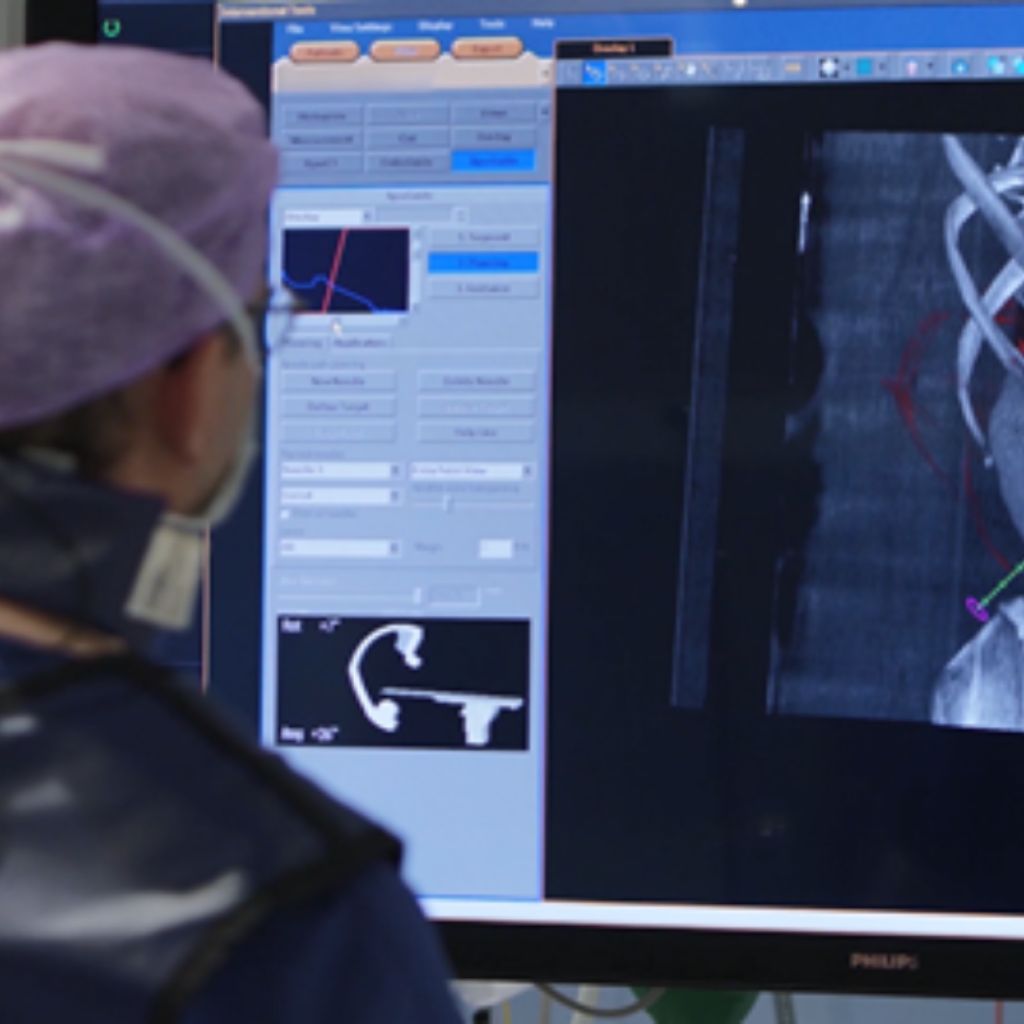 Tumor ablation with Marco van Strijen