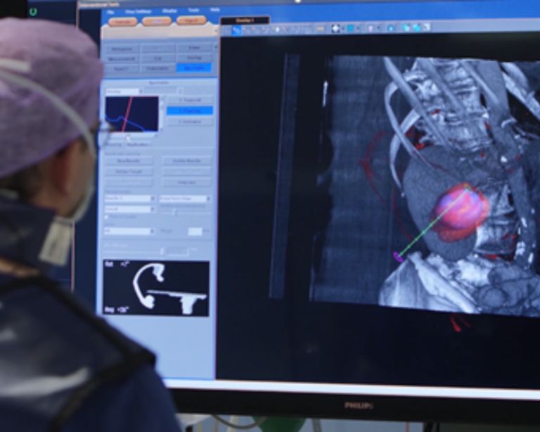 Tumor Ablation using Cone Beam CT and XperGuide