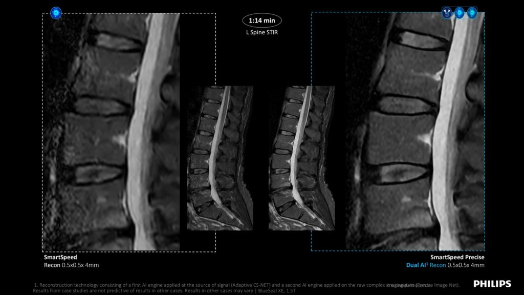 SmartSpeed Precise Spine Image Sharpness