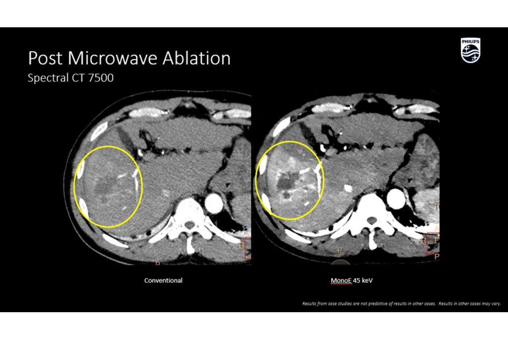 CT Spectral 7500 Post Microwave Ablation