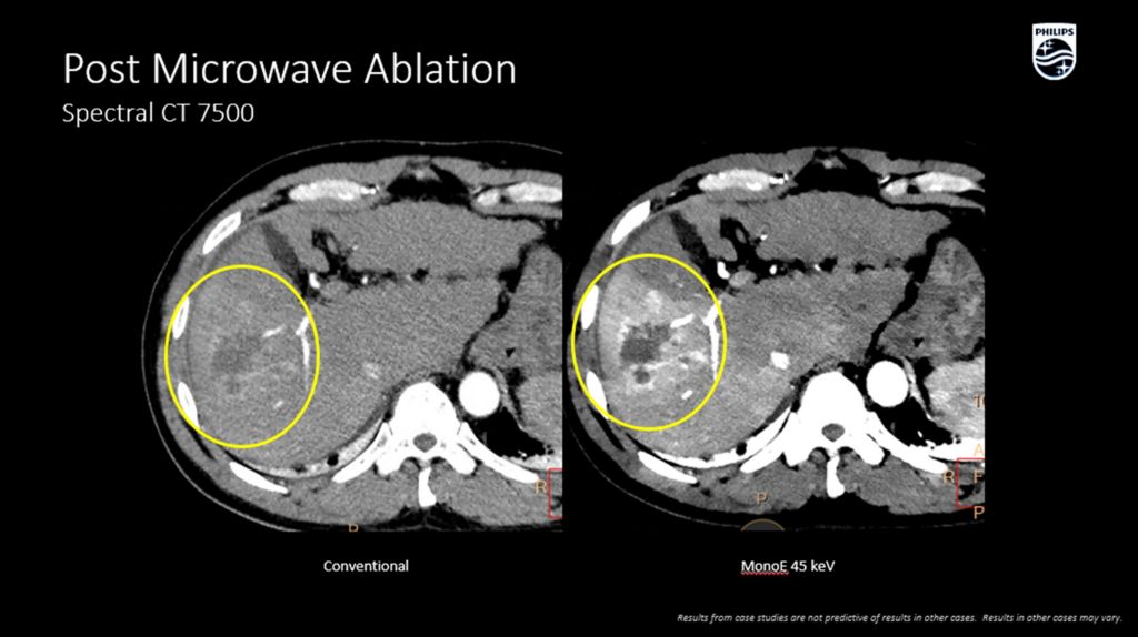 CT Spectral 7500 Post Microwave Ablation