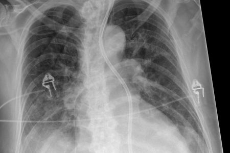 Röntgen ohne Streustrahlenraster​