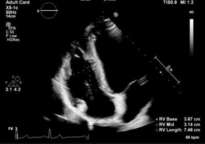 Right ventricle echo measurement view