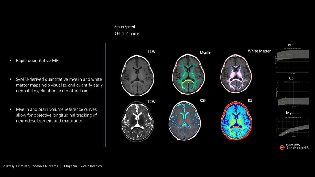The patient was referred for developmental delay. The quantitative graphs correlate with the imaging findings. The brain parenchyma appears slightly atrophic. That is why the BPF% is below normal. 


