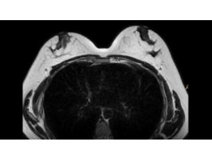 SmartSpeed MotionFree Body - Breast MR Clinical Applications