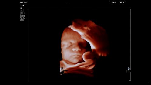 Fetal image shown with TrueVue on V6-2 transducer