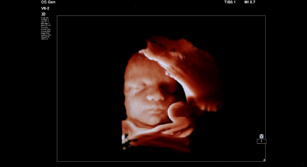 Fetal image shown with TrueVue on V6-2 transducer