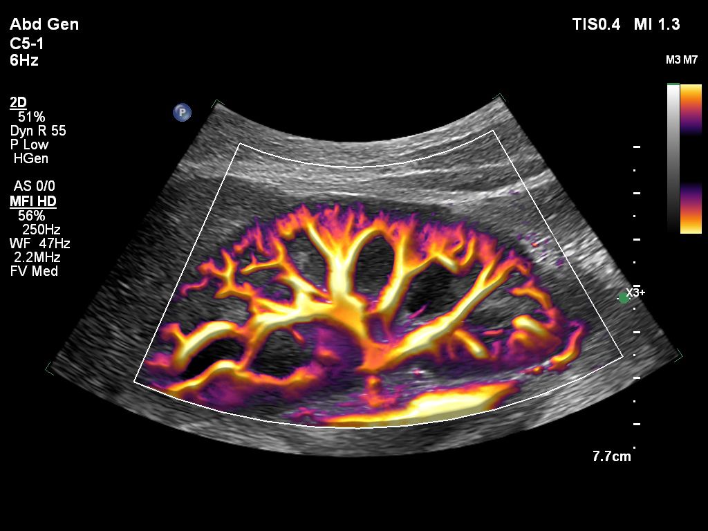 C5-1 Abd Gen EPIQ MFI HD