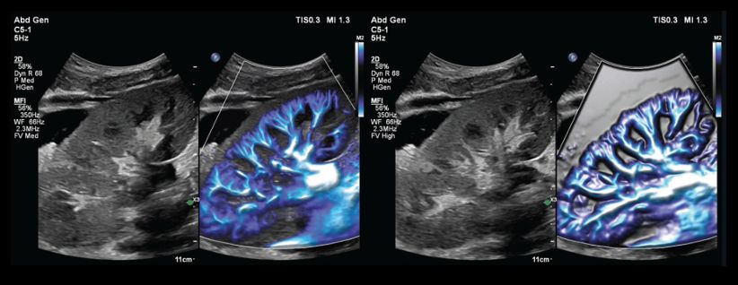 Left: MFI frame from a renal scan, with Flow Viewer turned on and blending between the MFI and B-mode data. Right: Different MFI frame from the same renal scan, with Flow Viewer again turned on but without blending between the MFI and B-mode data (solid MFI background). 