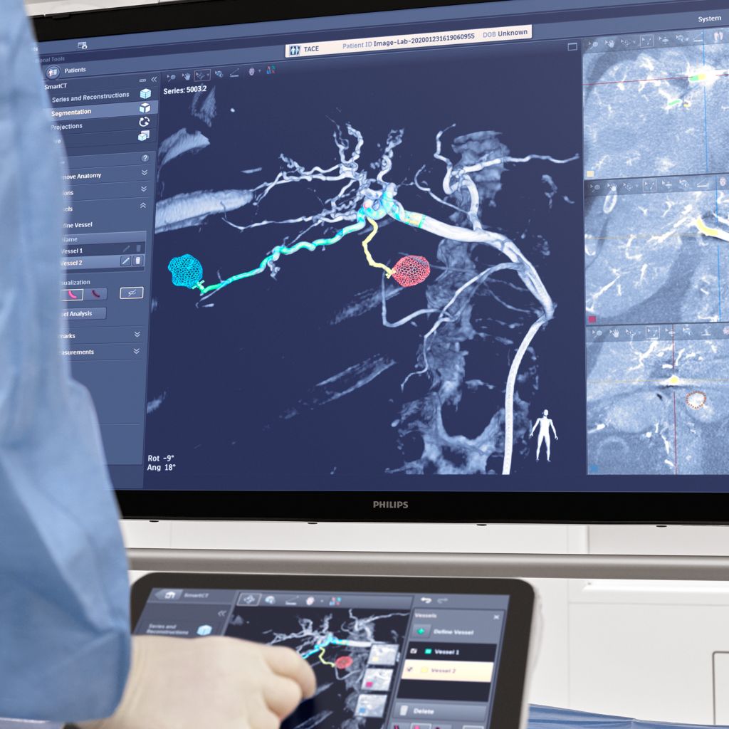 Azurion SmartCT Onco TACE Overview Segmentation