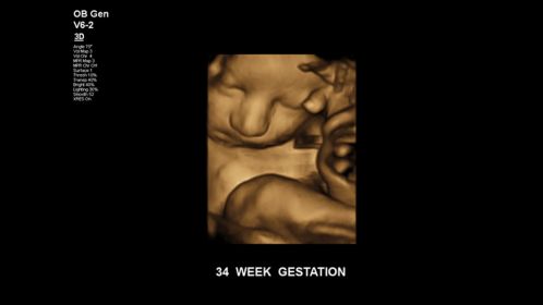 Fetus at 34 weeks gestation