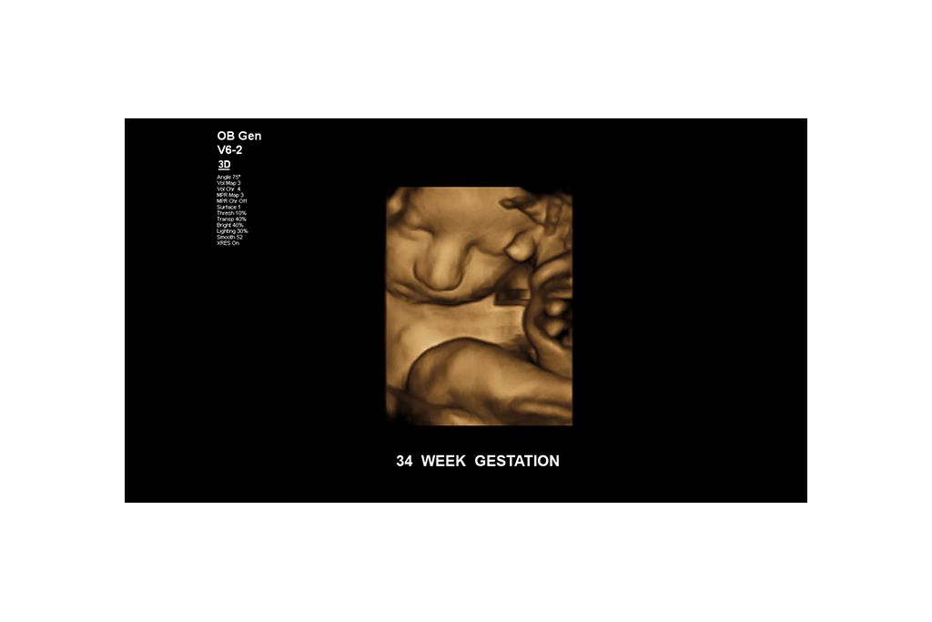Fetus at 34 weeks gestation