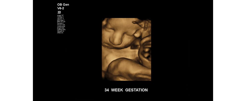 Fetus at 34 weeks gestation