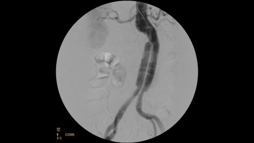 Clinical Image Philips BV Mobile C-arm Pulsera
