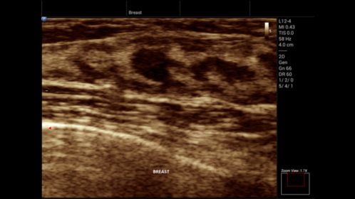 Innosight clinical image breast