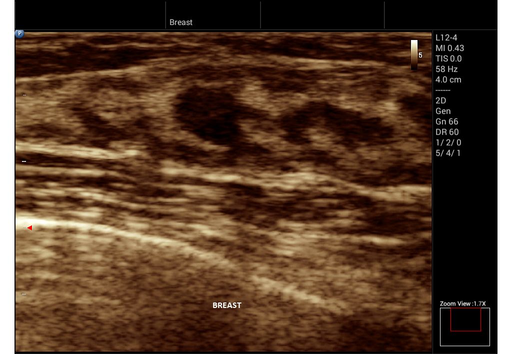 Innosight clinical image breast