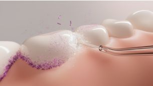 Gentle yet effective plaque removal
