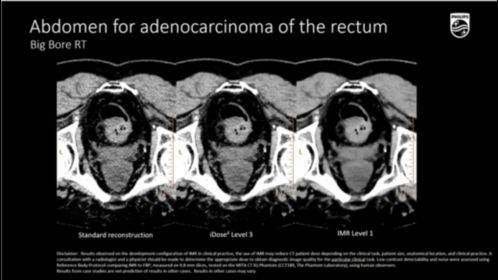 BBRT Abdomen for adenocarcinoma of the rectum