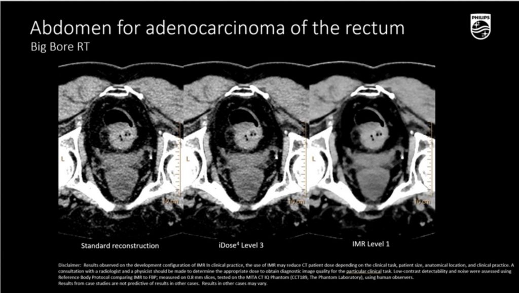 BBRT Abdomen for adenocarcinoma of the rectum