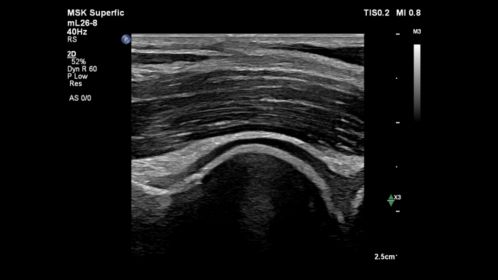 mL26-8 on an Elbow
