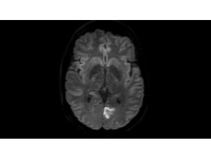 DWI-TSE Klinische MR-Anwendung