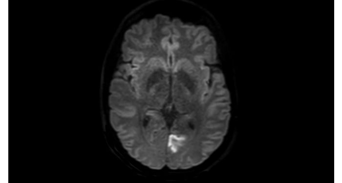 DWI TSE Brain MR Clinical application | Philips
