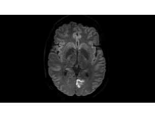 DWI TSE — obrazowanie mózgu Zastosowania kliniczne obrazowania MR