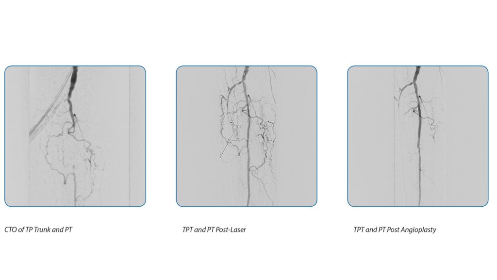 Turbo-Elite: pre & post procedure