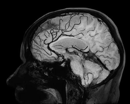 Vasculatis on Black Blood imaging