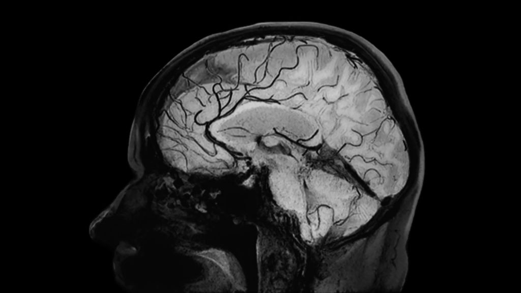 Sagittal 3D Black Blood imaging (MinIP)