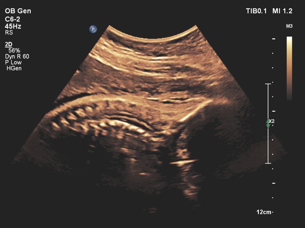 Affiniti 30 ultrasound clinical image obstetric