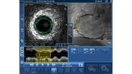 Go beyond the angiogram