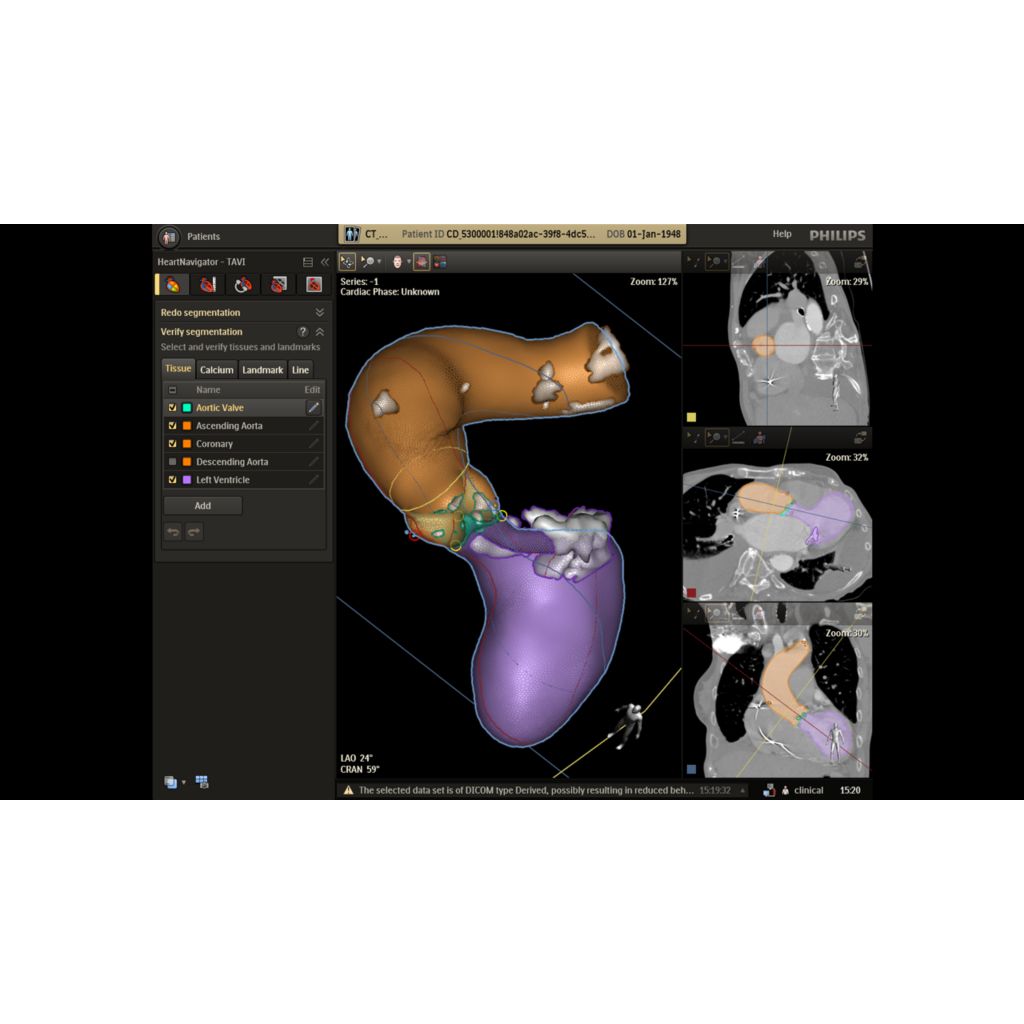 Calcification visualization to avoid potential complications